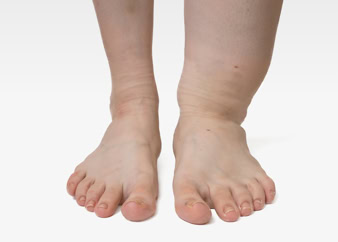 Lymphologie – Lymphödem Behandlung Passau