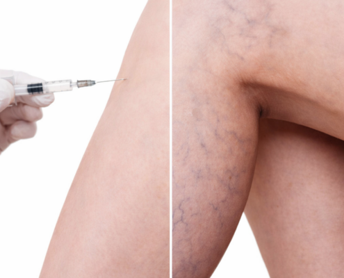 Mikrosklerotherapie_Besenreiser_01